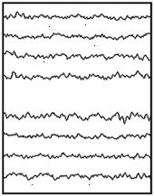 Normal EEG Normal EEG