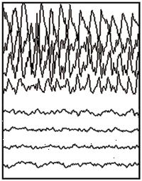 Partielle anfald EEG Partielle anfald EEG