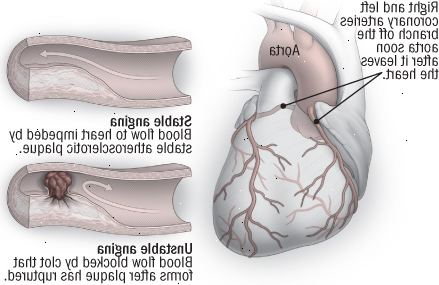 Stabil og ustabil angina Stabil og ustabil angina