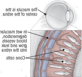 Makuladegeneration