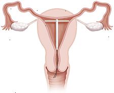 Tværsnit af livmoderen og skeden viser IUD på plads inde i livmoderen. Tværsnit af livmoderen og skeden viser IUD på plads inde i livmoderen.