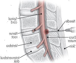 Et kig på to injektion behandlinger: epidural steroid injektion Et kig på to injektion behandlinger: epidural steroid injektion