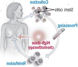 Stamcelle transplantation procedure Stamcelle transplantation procedure