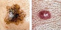 Foto sammenligne normale og melanom muldvarpe viser asymmetri Foto sammenligne normale og melanom muldvarpe viser asymmetri
