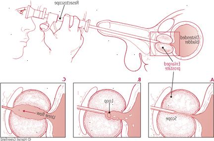 Prostata