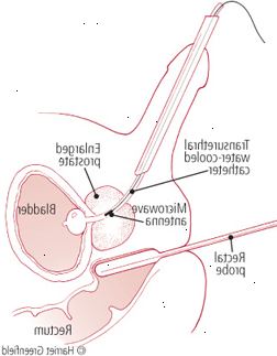 Prostata