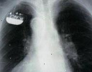 Røntgenbillede af et enkelt kammer indopereret pacemaker Røntgenbillede af et enkelt kammer indopereret pacemaker