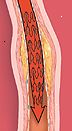 Blood flow forbedres