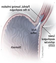 Halsbrand illustration