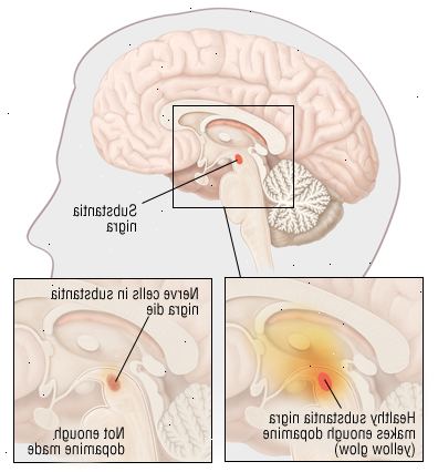 Parkinsons Parkinsons