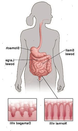 Skitse af den menneskelige figur, der viser fordøjelsessystem og påpege mave, tyndtarm og tyktarm. Detail viser normal villi som kødfulde fingerlike stilke foring tarm sammenlignet med kort, beskadiget villi.