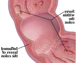 Crohns sygdom kan påvirke alle lag af fordøjelseskanalen.