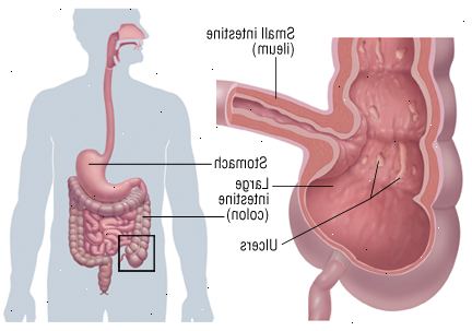 Crohns Crohns