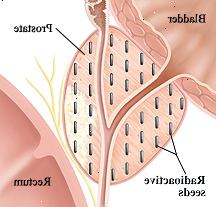 Closeup tværsnit af blære-, prostata-og rectum. Radioaktive korn implanteres hele prostata.