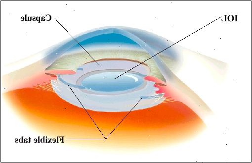 IOL folder, som det er indsat i øjets naturlige kapsel. Fleksible faner holde IOL på plads.