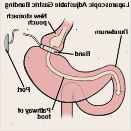 Front view af mavesækken og tolvfingertarmen viser laparoskopisk justerbar gastrisk banding. Band er omkring toppen af maven, hvilket skaber lille pose. Band er forbundet med rør til port lige under huden. Pil viser vej af fødevarer gennem mave pose, mave og duodenum. Front view af mavesækken og tolvfingertarmen viser laparoskopisk justerbar gastrisk banding. Band er omkring toppen af maven, hvilket skaber lille pose. Band er forbundet med rør til port lige under huden. Pil viser vej af fødevarer gennem mave pose, mave og duodenum.