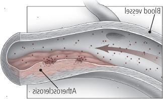 Inde i en indsnævret arterie Inde i en indsnævret arterie