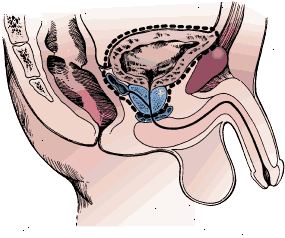 Kirurgiske grænser radikal cystectomy i en mand. Prøven omfatter blæren, prostata og sædblærer. Kirurgiske grænser radikal cystectomy i en mand. Prøven omfatter blæren, prostata og sædblærer.