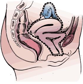 Kirurgiske grænser radikal cystectomy i en kvinde. Prøven omfatter blæren og hele urinrøret, livmoder, æggestokke, æggeledere, og forvæggen af skeden. Kirurgiske grænser radikal cystectomy i en kvinde. Prøven omfatter blæren og hele urinrøret, livmoder, æggestokke, æggeledere, og forvæggen af skeden.