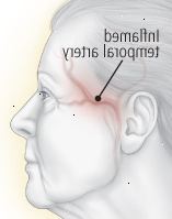Når det gør ondt at røre: temporal arteritis Når det gør ondt at røre: temporal arteritis