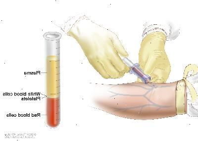 Komplet blodtælling (CBC). Blod opsamles ved at indsætte en nål i en vene og tillader blodet at strømme ind i et rør. Blodprøven sendes til laboratoriet, og de røde blodlegemer, hvide blodlegemer og blodplader tælles. CBC anvendes til at teste for, diagnosticere og overvåge mange forskellige sygdomme. Komplet blodtælling (CBC). Blod opsamles ved at indsætte en nål i en vene og tillader blodet at strømme ind i et rør. Blodprøven sendes til laboratoriet, og de røde blodlegemer, hvide blodlegemer og blodplader tælles. CBC anvendes til at teste for, diagnosticere og overvåge mange forskellige sygdomme.