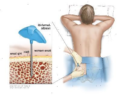 Knoglemarv aspiration og biopsi, tegning viser en patient liggende med forsiden nedad på et bord og en Jamshidi nål (en lang, hul nål) bliver indsat i hoftebenet. Indsatte viser Jamshidi nålen er indsat gennem huden ind i knoglemarven af hoftebenet. Knoglemarv aspiration og biopsi, tegning viser en patient liggende med forsiden nedad på et bord og en Jamshidi nål (en lang, hul nål) bliver indsat i hoftebenet. Indsatte viser Jamshidi nålen er indsat gennem huden ind i knoglemarven af hoftebenet.