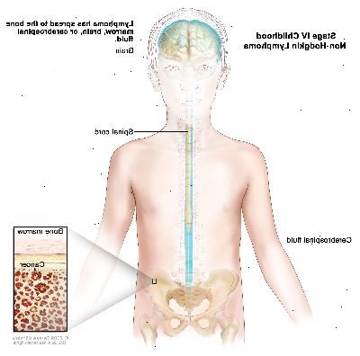 Stage IV barndommen non-Hodgkins lymfomer, tegning viser hjernen, rygmarven og cerebrospinalvæsken i og omkring hjernen og rygmarven. En indsatte viser kræft i knoglemarven. Stage IV barndommen non-Hodgkins lymfomer, tegning viser hjernen, rygmarven og cerebrospinalvæsken i og omkring hjernen og rygmarven. En indsatte viser kræft i knoglemarven.