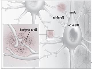 Beta-amyloid plaque