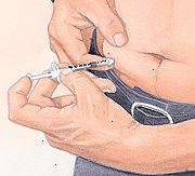 Patient injicering insulin i maven