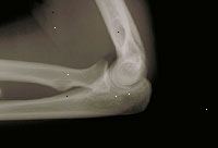 Et billede af en x-ray af albuen