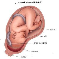 Illustration viser total placenta previa Illustration viser total placenta previa