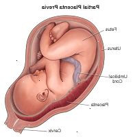Illustration viser partiel placenta previa Illustration viser partiel placenta previa