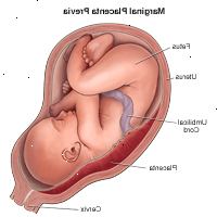 Illustration af marginal placenta previa Illustration af marginal placenta previa