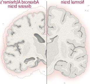 Ændringer i hjernen ved Alzheimers sygdom Ændringer i hjernen ved Alzheimers sygdom