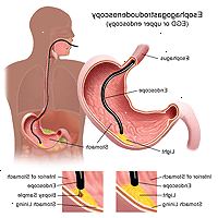 Illustration af en esophagogastroduodenoscopy procedure Illustration af en esophagogastroduodenoscopy procedure