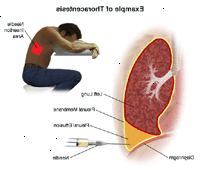 Illustration af en thoracentesis procedure