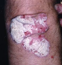 Psoriasis Psoriasis