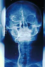 Billede af en carotis angiogram