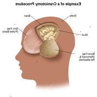 Illustration af et eksempel på en kraniotomi procedure