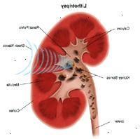 Illustration af litotripsi