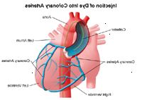 Illustration af kranspulsårerne efter injektion af farvestof, der anvendes i hjertekateterisation eller PTCA