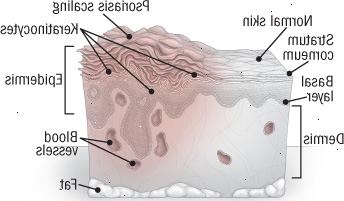 Anatomi af psoriasis Anatomi af psoriasis