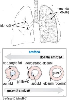 Astma: en reversibel sygdom