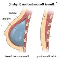 Illustration af et bryst siden, før og efter genopbygning (implantat) Illustration af et bryst siden, før og efter genopbygning (implantat)