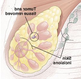 Breast anatomi med cirkel omkring tumor i kanalen viser væv, der skal fjernes. Der er stiplede linjer over brystvorten og i armhule at vise små buede indsnit sites. Breast anatomi med cirkel omkring tumor i kanalen viser væv, der skal fjernes. Der er stiplede linjer over brystvorten og i armhule at vise små buede indsnit sites.