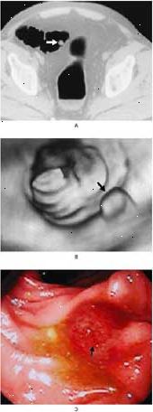 Colorectal polyp i colon sigmoideum ses af CT-scanning (A), virtuel koloskopi (B), og konventionelle koloskopi (C). Colorectal polyp i colon sigmoideum ses af CT-scanning (A), virtuel koloskopi (B), og konventionelle koloskopi (C).