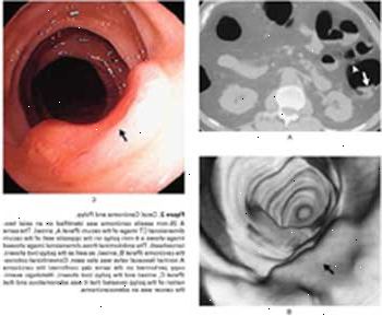 Cecal carcinom og polyp ses ved CT-scanning (A), virtuel koloskopi (B), og konventionelle koloskopi (C). Cecal carcinom og polyp ses ved CT-scanning (A), virtuel koloskopi (B), og konventionelle koloskopi (C).
