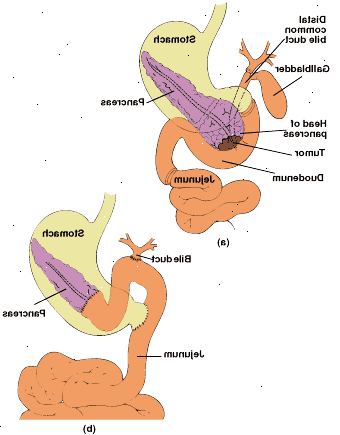 Pylorus-bevarelse pancreaticoduodenectomy: anatomi resekterede område (a) og tilsluttes fordøjelseskanalen med ende-til-ende pancreaticojejunostomy (b). Pylorus-bevarelse pancreaticoduodenectomy: anatomi resekterede område (a) og tilsluttes fordøjelseskanalen med ende-til-ende pancreaticojejunostomy (b).
